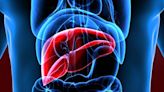 MRE-liver stiffness measure better for varices in NAFLD cirrhosis