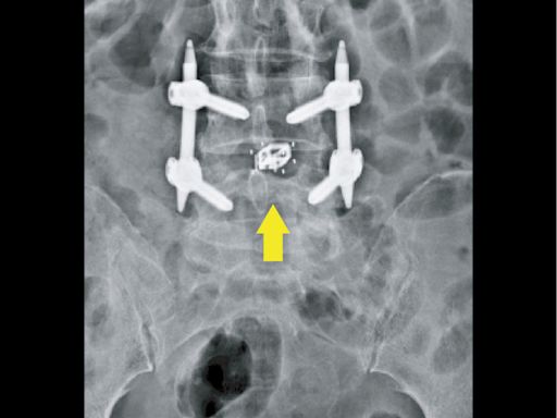7旬婦腰椎滑脫痛到腳麻 手術置撐開型支架改善 - 自由健康網