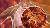 Tuberculosis case confirmed at Chester High School: DHEC
