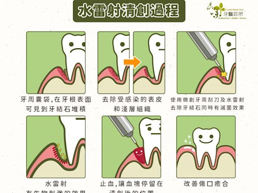 牙周病治療新福音 水雷射可深層滅菌又不怕牙齦大幅萎縮