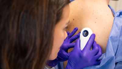 Melanoma Skin Cancer Is At An All Time High In The UK, These Are The Signs To Look For