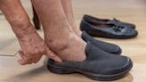 Edema (Swelling): Causes, Treatment, and More