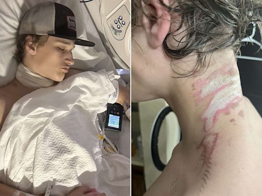 16-Year-Old Electrocuted by His Necklace in Freak Accident: 'It Was Like a Hot Coil'