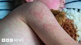 Measles: Cases rise in Northern Ireland and Republic of Ireland