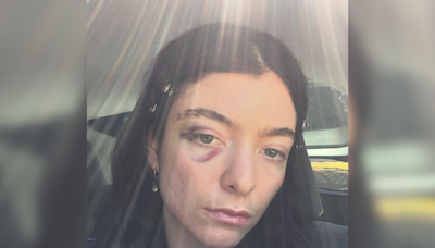 Lorde fans express concern after singer shares selfie with black eye