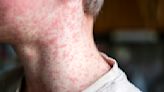 Ontario records first measles death since 1989. What parents need to know about the disease & vaccination