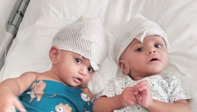 Rare conjoined twin girls separated after 14 hour operation