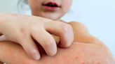 Chicken Pox Cases Rise 200% Among Montana’s School-Aged Children