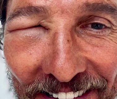 Matthew McConaughey alarma a sus fans tras estas imágenes con la cara hinchada y desfigurada