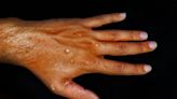 WHO investigates reports of monkeypox virus in semen