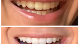 Shoppers hail 'best ever' teeth whitening solution that removes 'years of stains' in 3 for 2 offer