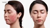 How to manage rosacea: from common triggers to the best treatments