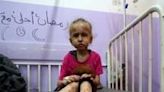 A Palestinian child awaits malnourishment treatment at Al-Aqsa Martyrs Hospital on May 30, 2024