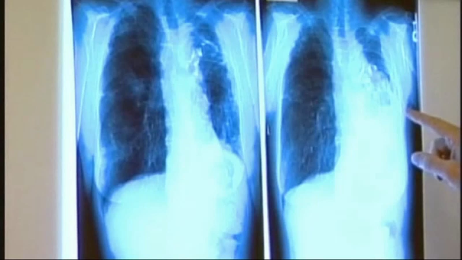 Long Beach declares health emergency over tuberculosis outbreak, 1 person dead