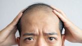 Calvitie : les scientifiques découvrent la cause "exacte" de la perte de cheveux, l’espoir d’un remède renaît