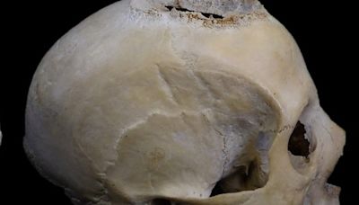 Ancient Egyptians Tried To Treat Brain Cancer, 4,000-Year-Old Skull Shows