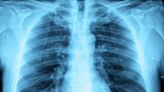 How to understand Ohio’s ‘white lung syndrome’ pneumonia outbreak — and why it’s not linked to China