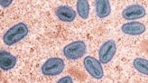 Researchers Identify Monkeypox Virus Genomic Changes Associated With Transmissibility