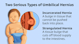 Umbilical Hernia: Identifying Symptoms and Weighing Surgery