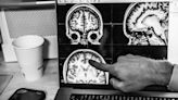 Aging white matter in the brain may affect stroke recovery, study finds