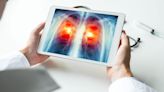 Just 18% of Americans who need lung cancer screenings get one