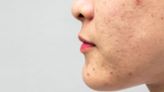 How to Get Rid of Clogged Pores, According to Dermatologists