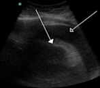 Cardiac tamponade