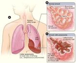 Lobar pneumonia