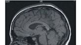 Asocian desarrollo de enfermedades cerebrales con dos químicos habituales en hogares