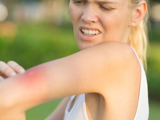 Estos factores aumentan las posibilidades de que te piquen los mosquitos