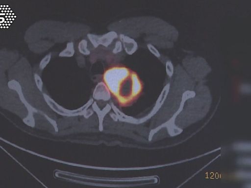 罹患「這個癌」年輕化關鍵因素是「它」！醫師：過半發現已晚期│TVBS新聞網