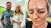 Woman almost blinded after piercing eyeball on glass shard in freak injury