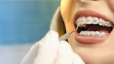 If You're Thinking Of Getting Adult Braces, Here's What To Keep In Mind