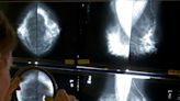 Experts: Mammograms should start at 40 to address rising breast cancer rates at younger ages