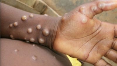 Africa CDC calls for enhanced surveillance, detection as monkeypox cases surpass 32,400