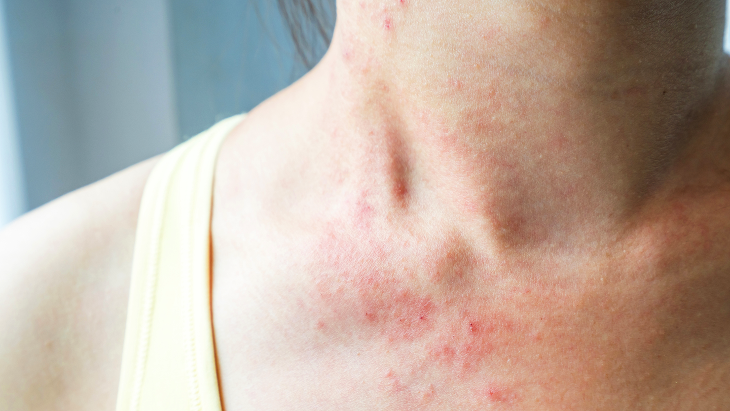 These Pictures Will Help You Identify the Most Common Skin Rashes