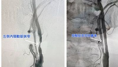 嚴重頸動脈狹窄釀中風症狀 頸動脈支架置放術助改善