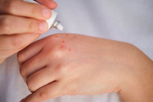 Hand Rash: 12 Possible Causes and Treatment Options