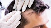 How Does Propecia Work For Hair Loss? Everything You Need to Know
