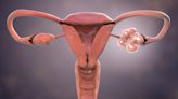 A malaria drug could help treat polycystic ovary syndrome