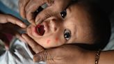 'Staggering': Measles deaths have nearly doubled globally, according to new CDC data. Here's why.