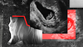 Explaining Jessa Duggar Seewald's spontaneous abortion and dilation and curettage procedure