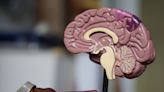 Research challenges link between motor impairment and brain injury