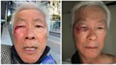 'I'm lucky to be alive': SF commissioner-at-large punched in the face in unprovoked attack
