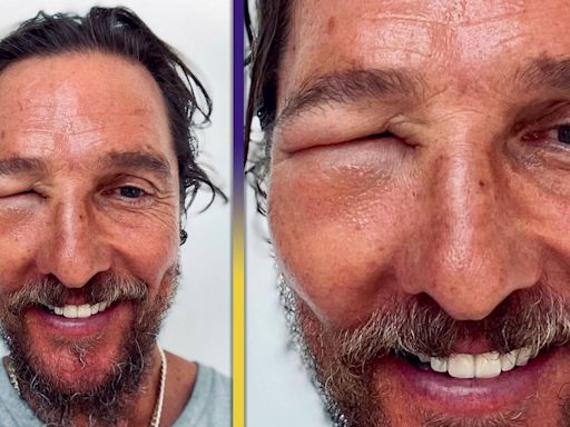 Matthew McConaughey Shows Off Wild Bee Sting Swelling