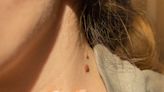 Experts Explain Why You Should Never Try to Remove a Skin Tag Yourself