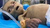 Doctors visiting a Gaza hospital are stunned by the war's toll on Palestinian children