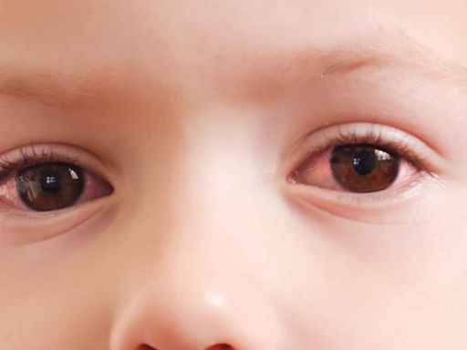 Causes and symptoms of myopia in children: Expert tips to correct vision, prevent eye strain