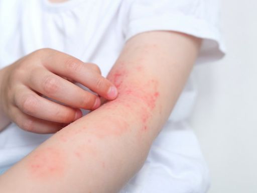 Dermatite, psoríase e mais: veja 6 doenças de pele agravadas no inverno e como evitar crises