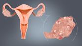 Polycystic ovary syndrome